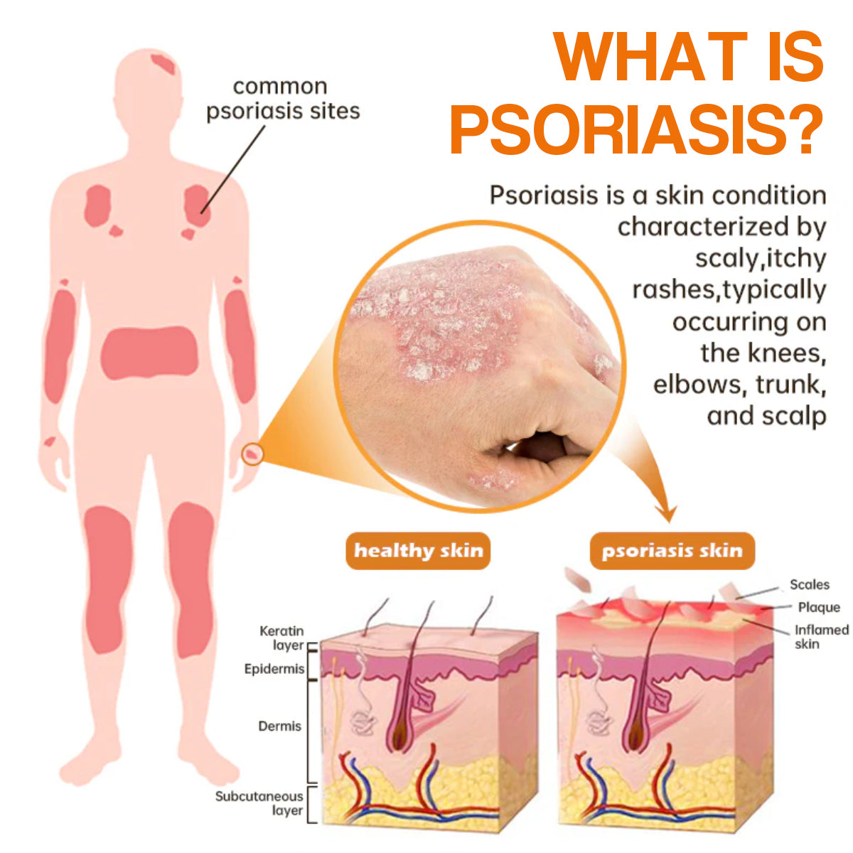 ✨【 official  Brand  Store】  Last Day Discount: 83% OFF 🌸 LOVILDS™ PsoriaHeal  psoriasis Spray pro