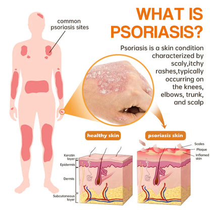 ✨【 official  Brand  Store】  Last Day Discount: 83% OFF 🌸 LOVILDS™ PsoriaHeal  psoriasis Spray pro