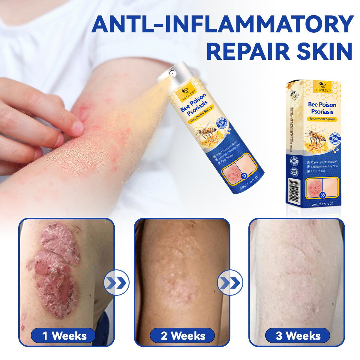 ✨【 official  Brand  Store】  Last Day Discount: 83% OFF 🌸 LOVILDS™ PsoriaHeal  psoriasis Spray pro