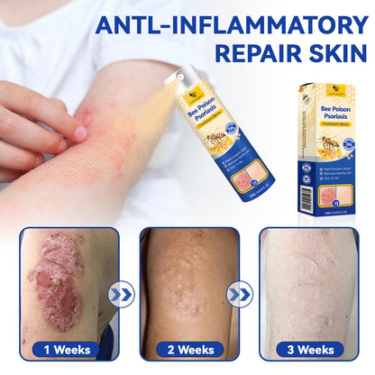 ✨【 official  Brand  Store】  Last Day Discount: 83% OFF 🌸 LOVILDS™ PsoriaHeal  psoriasis Spray pro