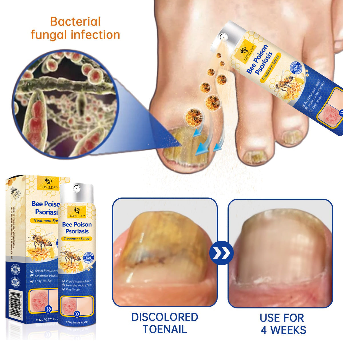 ✨【 official  Brand  Store】  Last Day Discount: 83% OFF 🌸 LOVILDS™ PsoriaHeal  psoriasis Spray pro