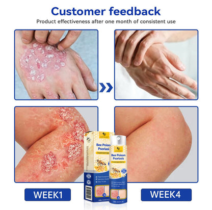 ✨【 official  Brand  Store】  Last Day Discount: 83% OFF 🌸 LOVILDS™ PsoriaHeal  psoriasis Spray pro