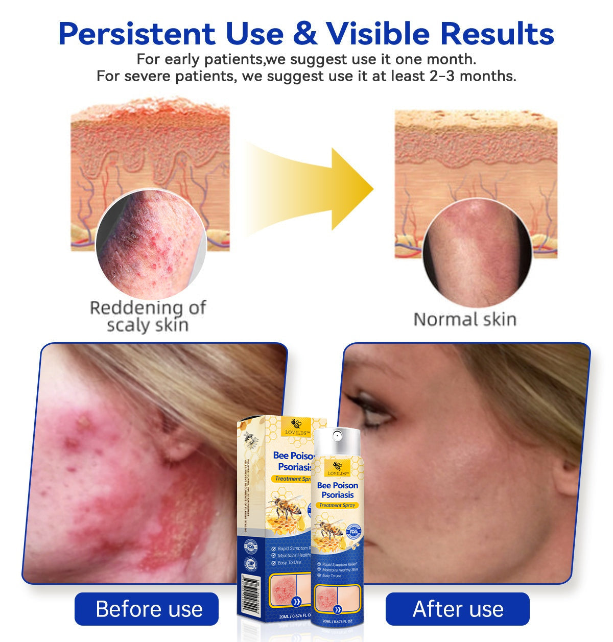 ✨【 official  Brand  Store】  Last Day Discount: 83% OFF 🌸 LOVILDS™ PsoriaHeal  psoriasis Spray pro