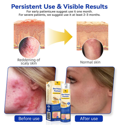 ✨【 official  Brand  Store】  Last Day Discount: 83% OFF 🌸 LOVILDS™ PsoriaHeal  psoriasis Spray pro