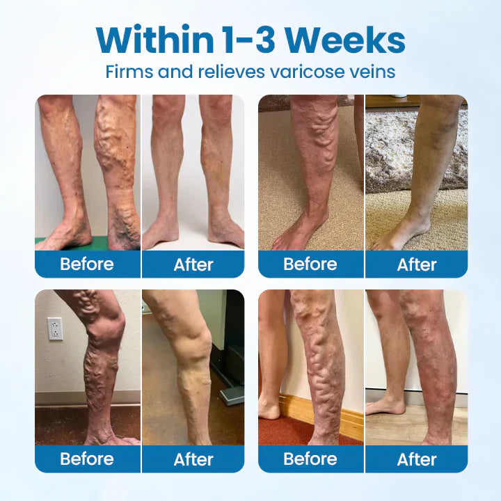 Lovilds™ VeinGuard Herbal Spray-✅ Clinically proven to eliminate varicose veins in just 7 days!