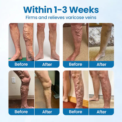 Lovilds™ VeinGuard Herbal Spray-✅ Clinically proven to eliminate varicose veins in just 7 days!