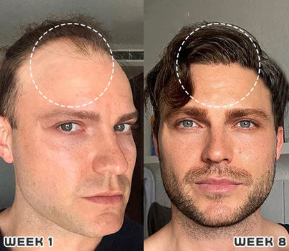 Last Day Promotion 70% OFF - 🔥Put an end to hair loss with LOVILDS™ Foaming Serum!