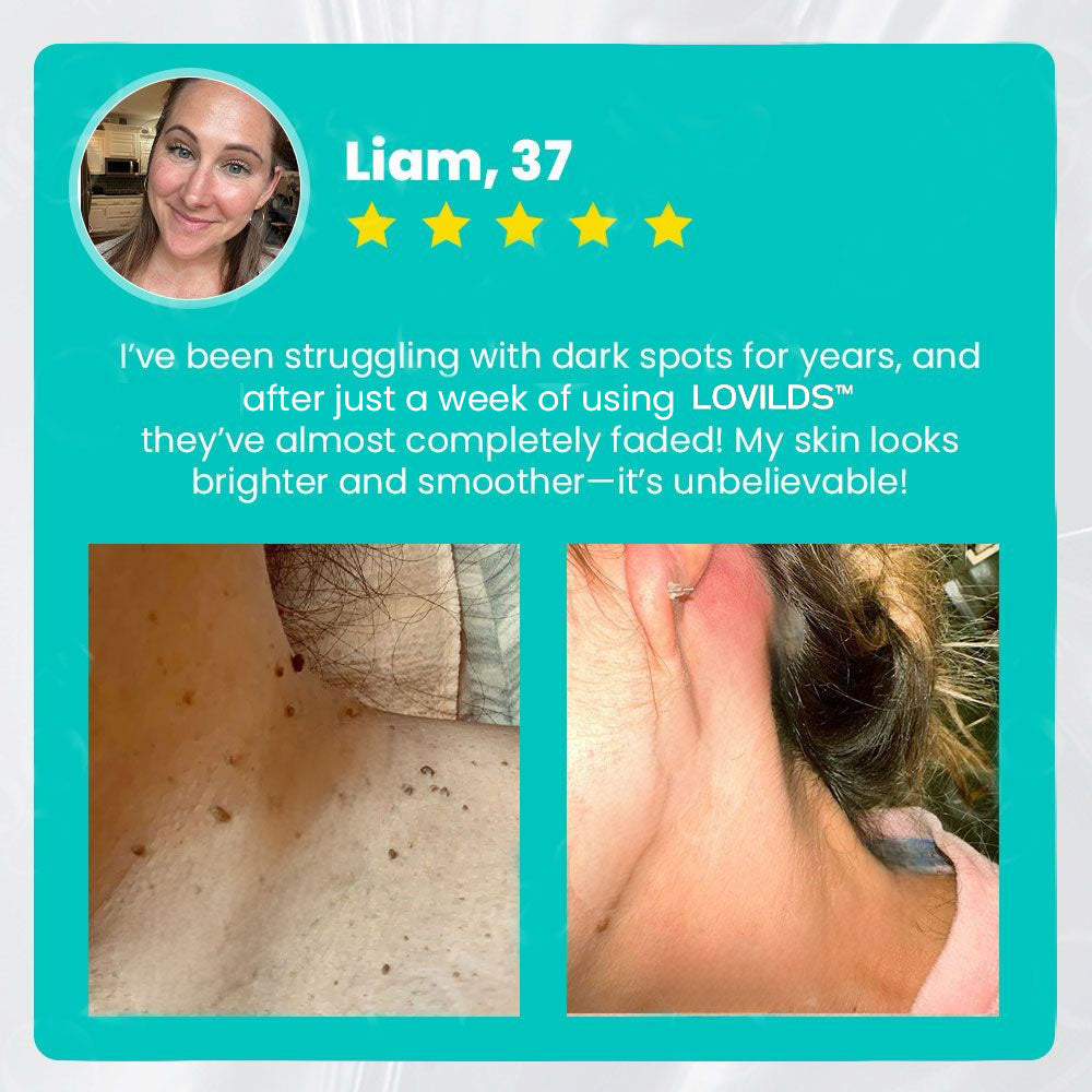 ✅ Official Store:  Ultra LOVILDS™ Instant Mole & Spot Removal Gel