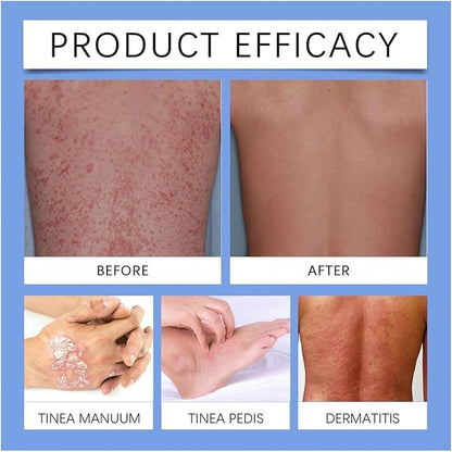 ✨【 official  Brand  Store】  Last Day Discount: 83% OFF 🌸 LOVILDS™ PsoriaHeal  psoriasis Spray pro