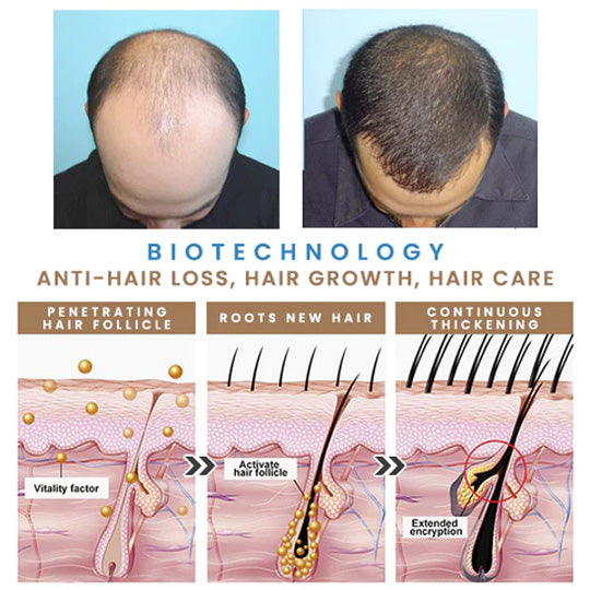 Last Day Promotion 70% OFF - 🔥Put an end to hair loss with LOVILDS™ Foaming Serum!