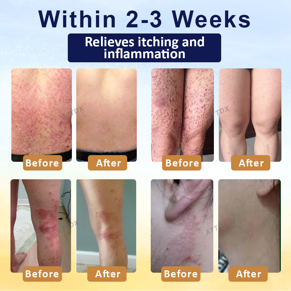 LOVILDS™ Psoriasis Care Mellifera Venom Skin Healing Spray🔥