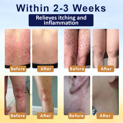 LOVILDS™ Psoriasis Care Mellifera Venom Skin Healing Spray🔥