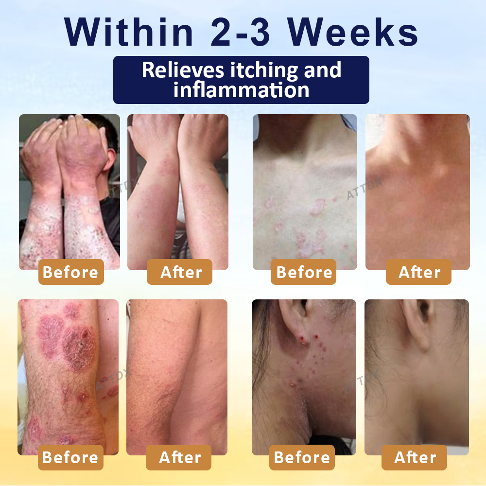 LOVILDS™ Psoriasis Care Mellifera Venom Skin Healing Spray🔥