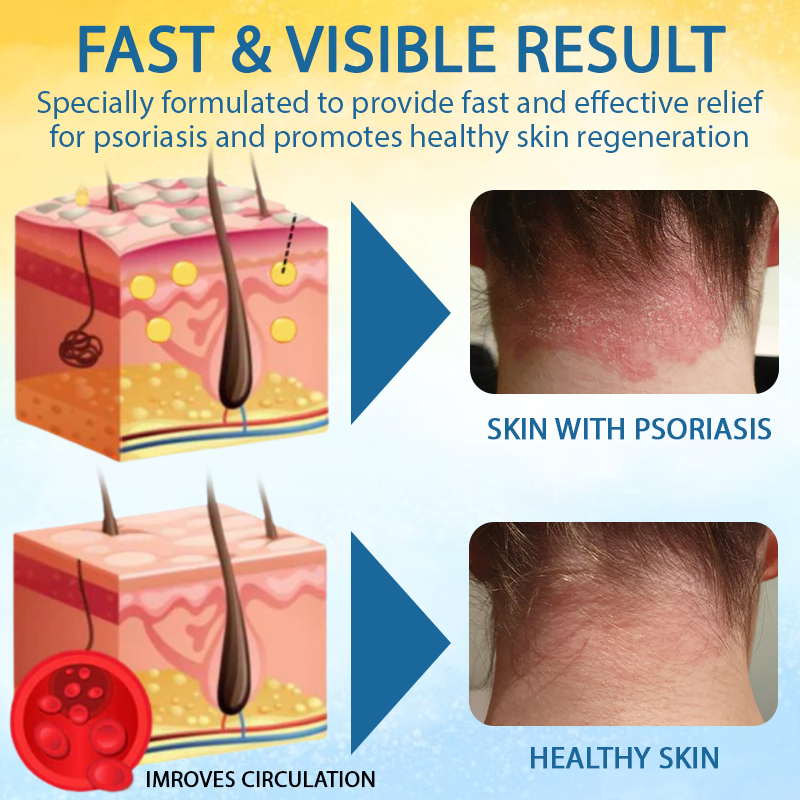 LOVILDS™ Psoriasis Care Mellifera Venom Skin Healing Spray🔥