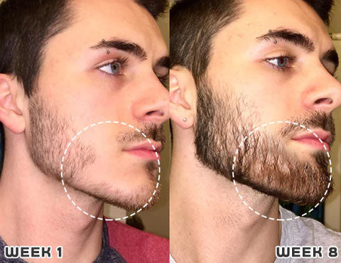 Last Day Promotion 70% OFF - 🔥Put an end to hair loss with LOVILDS™ Foaming Serum!