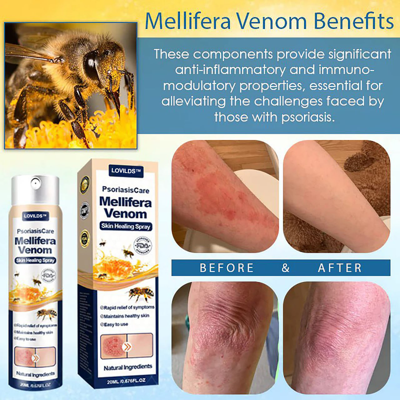 LOVILDS™ Psoriasis Care Mellifera Venom Skin Healing Spray🔥